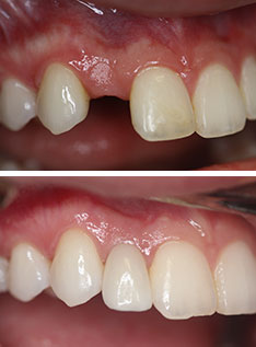 Immediate Dental Implant Beverly Hills before-after
