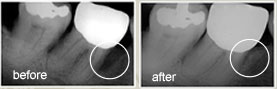 Bone Grafting Dental Beverly Hills image