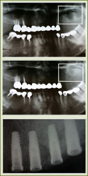 Sinus Augmentation image