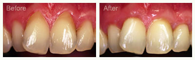 soft-tissue-graft-procedure-before-after