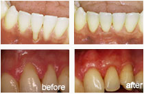 soft-tissue-grafts-before-after