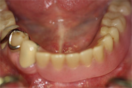 Dental Implant Supporting Partial Denture-result