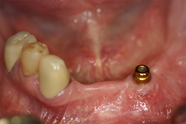 Dental Implant Supporting Partial Denture-procedure