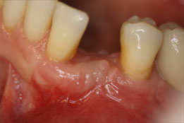 Esthetic Crown Lengthening image9-after