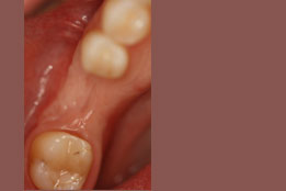 Esthetic Crown Lengthening image8-after