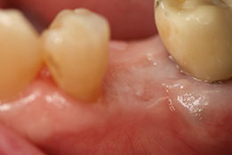 Esthetic Crown Lengthening image10-after