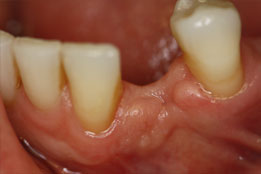 Esthetic Crown Lengthening image9-before