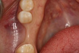 Esthetic Crown Lengthening image8-before