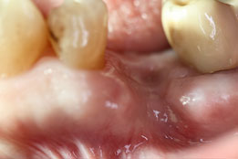 Esthetic Crown Lengthening image 10-before