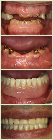 Dental Implants Full Overdenture image