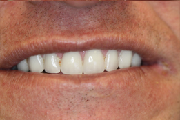 Dental Implants Full Fixed Prosthesis image-After
