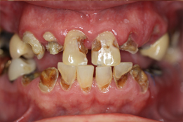 Dental Implants Full Fixed Prosthesis image-Before