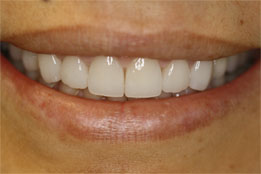 Esthetic Crown Lengthening after