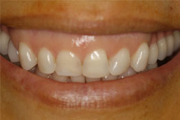 Esthetic Crown Lengthening before