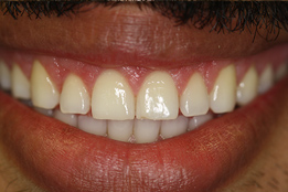 Esthetic Crown Lengthening after