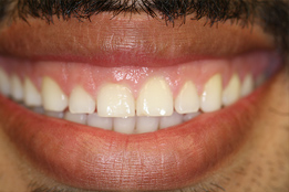 Esthetic Crown Lengthening before