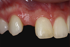 dental implant in los angeles before photo