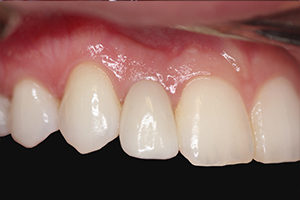 dental implant in los angeles after photo