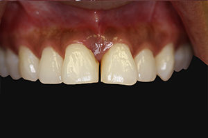 dental implant before photo