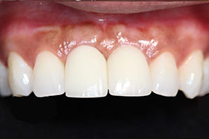 dental implant after photo