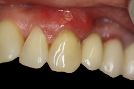 gum grafting after photo