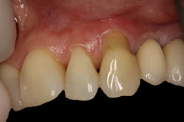 gum grafting before photo