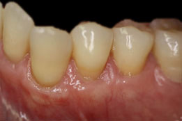 soft tissue grafting after photo