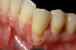 soft tissue grafting before photo