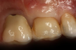 soft tissue grafting after photo