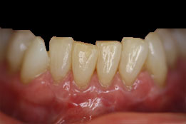 Xenograft Soft Tissue after