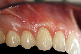 soft-tissue-grafting-after