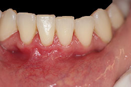 soft-tissue-grafting-after