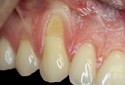 soft-tissue-grafting-before