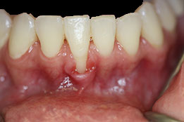 soft-tissue-grafting-before