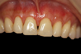 soft-tissue-grafting-after