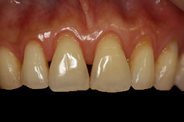 soft-tissue-grafting-before